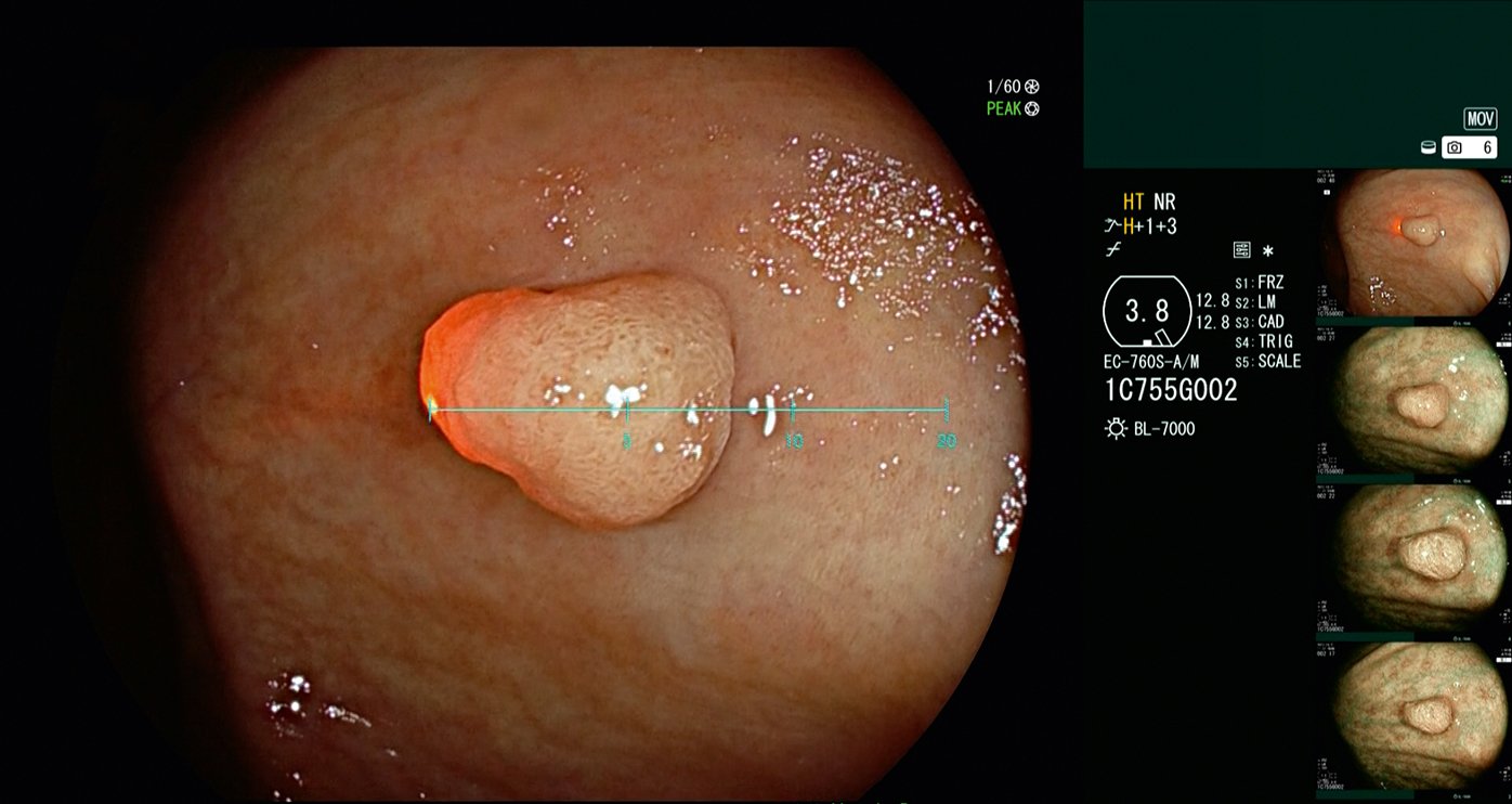 On the scale: polyp size