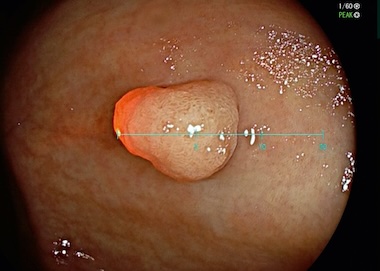 On the scale: polyp size