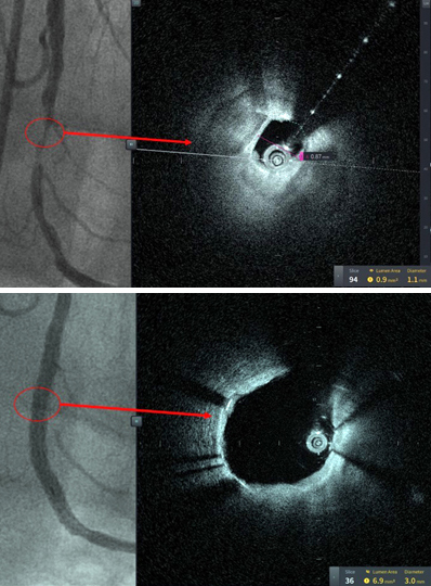 Images from first patient treated with HF-OCT at Tampa. Click for more info.