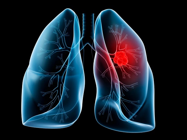 Lung cancer