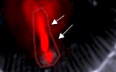 Danger signs: arterial plaques