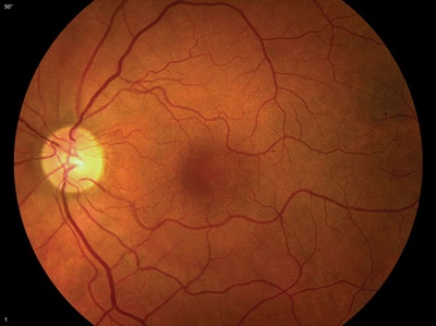 Retinal imaging