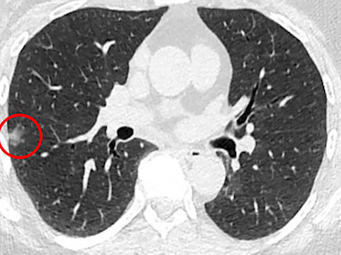 Identifying lesions: NIR tracer and endoscopy