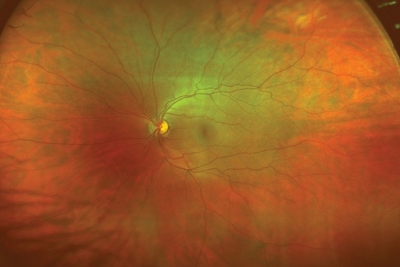 Retinal imaging