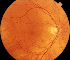 Normal retina