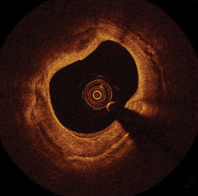 Inside blood vessels: the OCT view