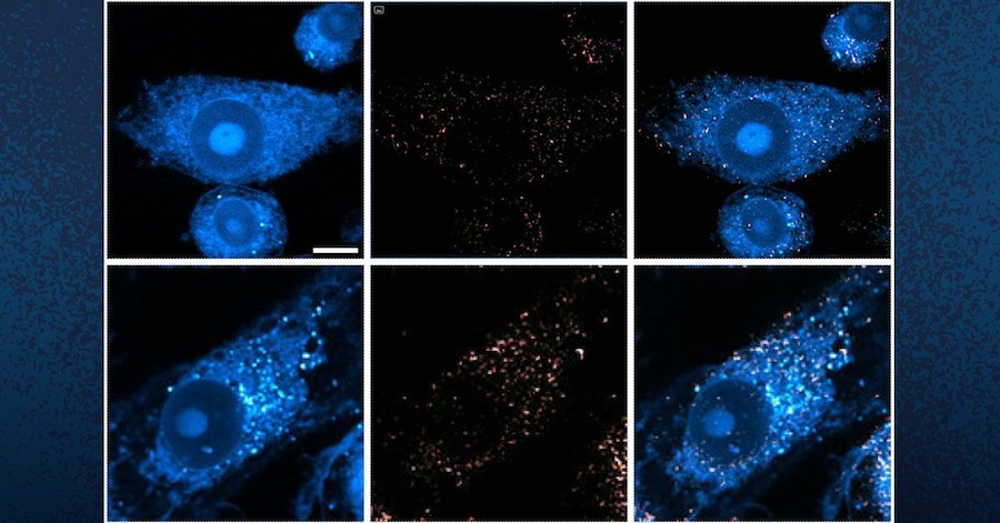 Disease progress: the role of lipids