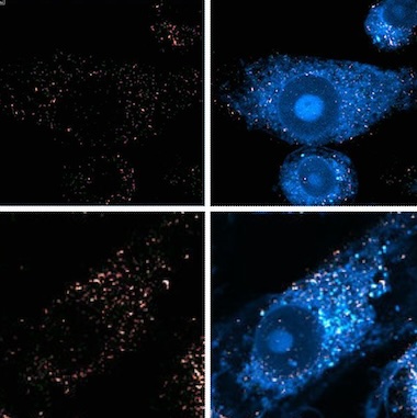 Disease progress: the role of lipids