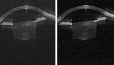 Value for money: OCT imaging